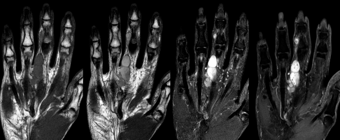 Figure 5 for case Plexiform schwannoma ( RID4480 )